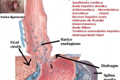 Varice-esofagiene-2