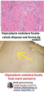 Un nodul hepatic poate fi hiperplazie nodulara focala