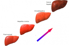 Evolutia-fibrozei-hepatice
